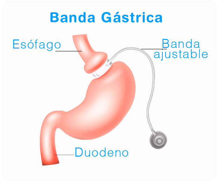 banda gastrica