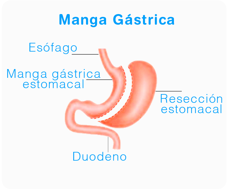 manga gastrica