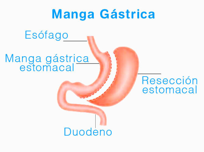 manga gastrica